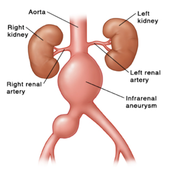 aortic aneurysms