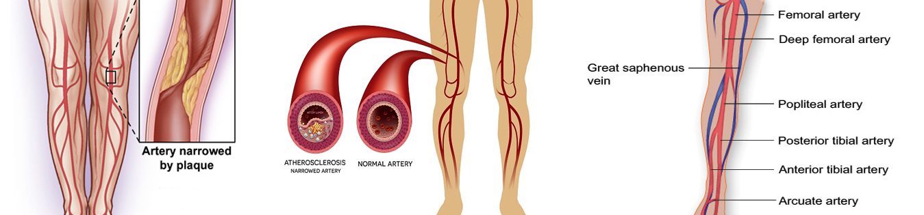 What-is-Vascular-diseases