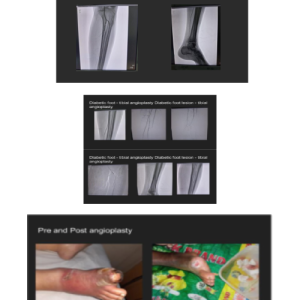 Novel therapies for diabetic foot problmes our success story of complex diabetic foot ulcer treted at our centre-1 (1)