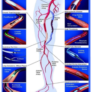 Novel therapies for diabetic foot problmes our success story of complex diabetic foot ulcer treted at our centre-1 (4)